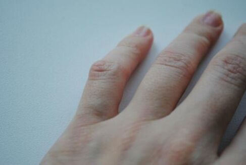 Na małym palcu pojawił się artretyczny guzek. 