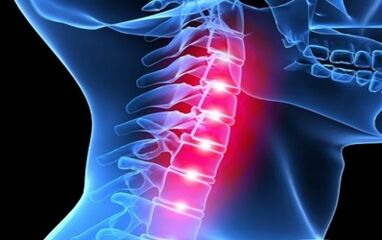Objawy osteochondrozy kręgosłupa szyjnego