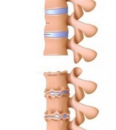 Etapy ramp osteochondrozy szyi