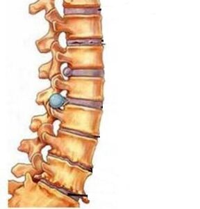 Jak rozwija się osteochondroza regionu szyjnego