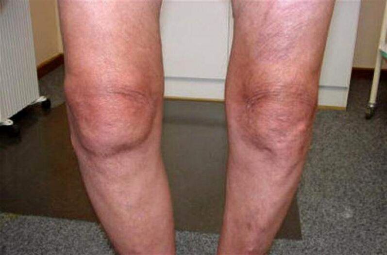obrzęk kolana z powodu zapalenia stawów
