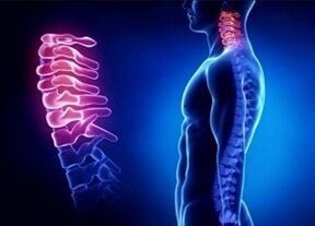 Przyczyny rozwoju osteochondrozy szyjki macicy
