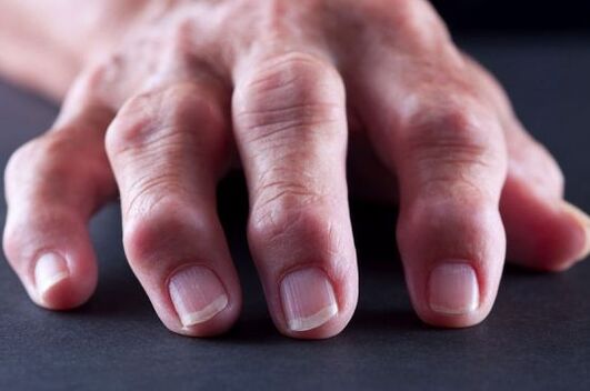 Deformacje stawowe palców spowodowane artrozą lub zapaleniem stawów
